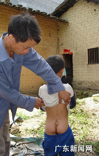 粤西信宜十龄童屁股长出形似<em>生殖器</em>尾巴